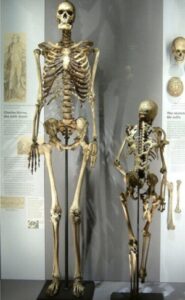 Charles Byrne, The Irish Giant, Hunterian Museum